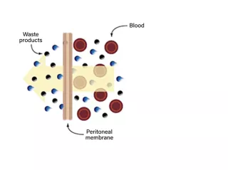 peritoneal waste